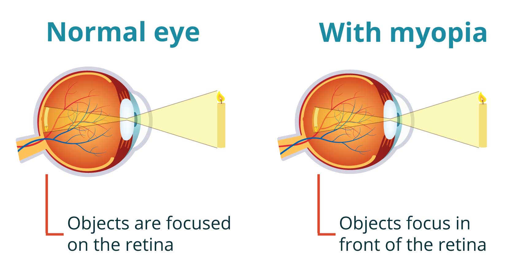 Myopia Management - Innovision Family Eye Care Tx.